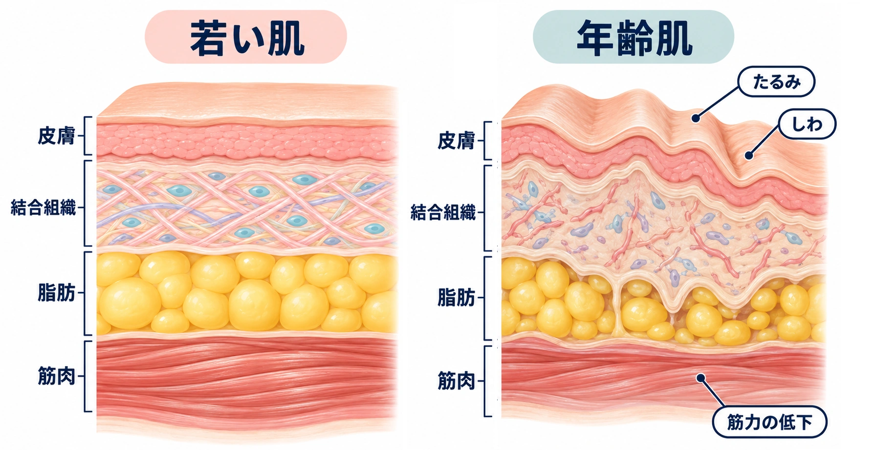 若い肌と年齢肌の皮膚、結合組織、脂肪、筋肉の違いを示したイラスト