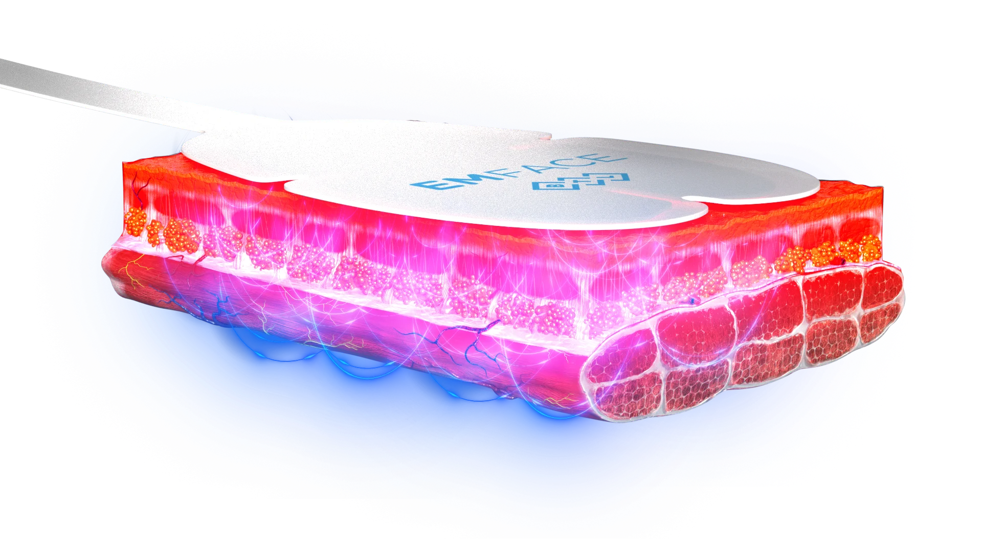 肌表面のアプリケーターから皮膚と筋肉へエネルギーを届けるイラスト
