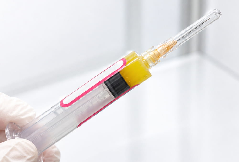 PRP療法の注射器を手袋をはめた手で持っている様子